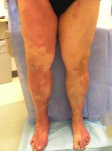 Klippel-Trenaunay Syndrome