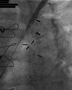Subclavian intervention figure 2