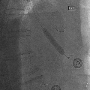 Mesenteric artery intervention