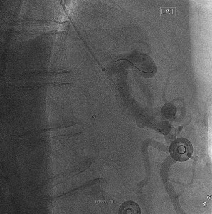 Mesenteric artery intervention