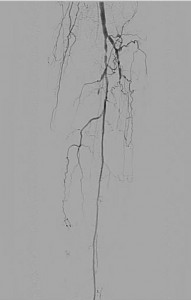 Critical limb ischemia