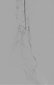 Critical limb ischemia