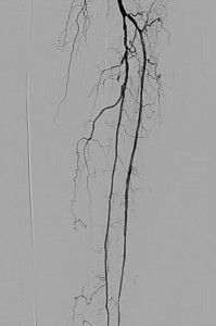 Critical limb ischemia