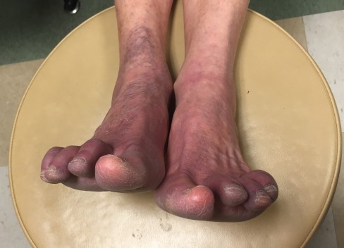 purple feet when sitting