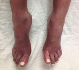 purple feet in elderly from acrocyanosis