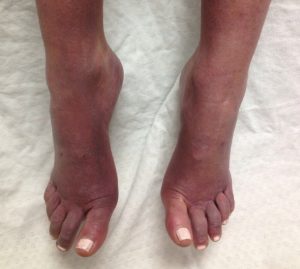 purple feet in elderly from acrocyanosis