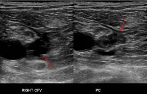 DVT complications; residual clot