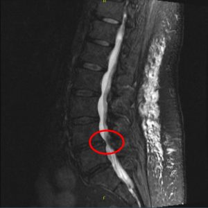 spinal stenosis