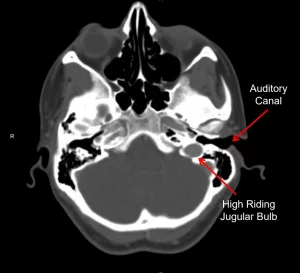 High riding jugular bulb