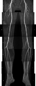 MRA runoff of the lower extremities