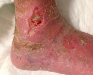 Venous Ulcer