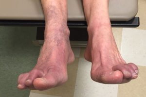 purple feet from acrocyanosis improving after elevation