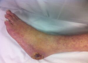 arterial ulcers