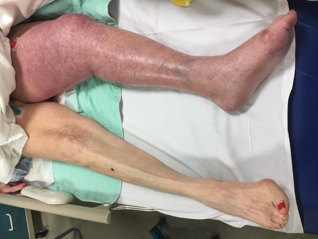 purple leg from a severe DVT