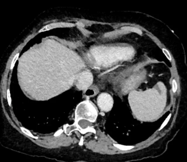Splenic infarct