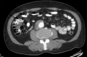 Inflammatory aortic aneurysm CTA