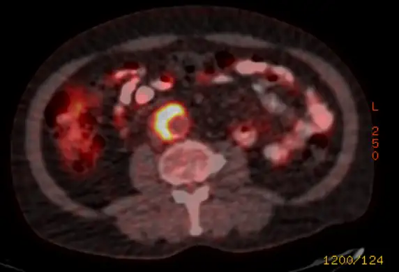 Inflammatory Aortic Aneurysm